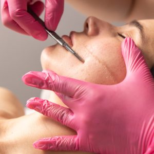 Dermaplaning